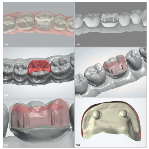 From Traditional Dentistry to Digital Innovation: A Modern Zirconia Pinlay Workflow